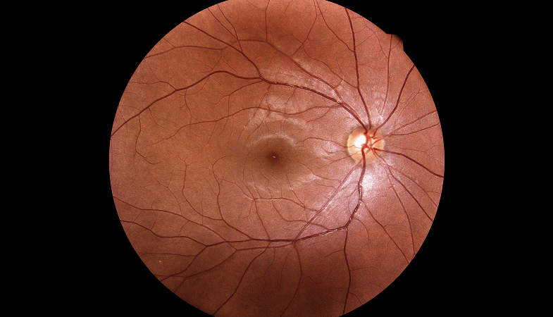 Retinal Vasculitis: It’s Significance