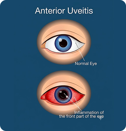 uveitis
